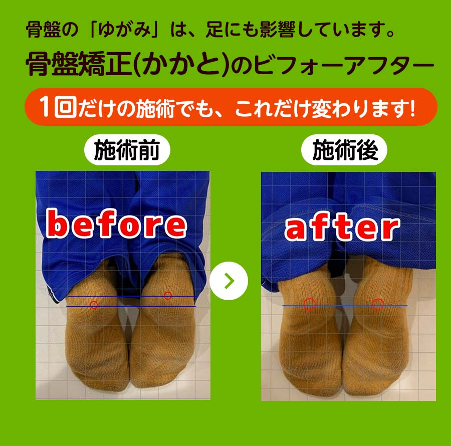 骨盤矯正と足のかかとBefore＆After