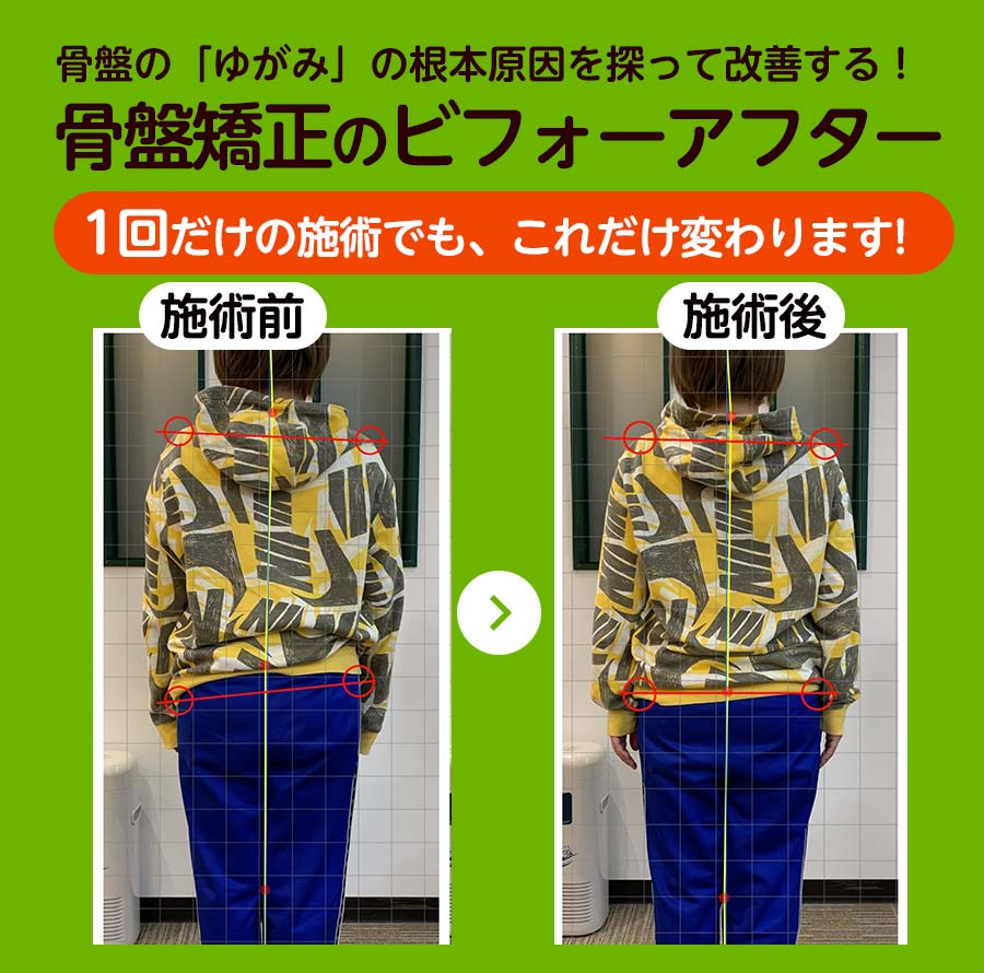 骨盤矯正Before＆After